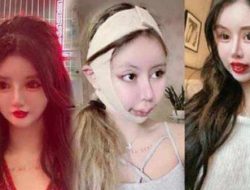 Gadis Remaja Ini Lakukan 100 Kali Operasi Plastik Demi Tampil Cantik, Begini Hasilnya