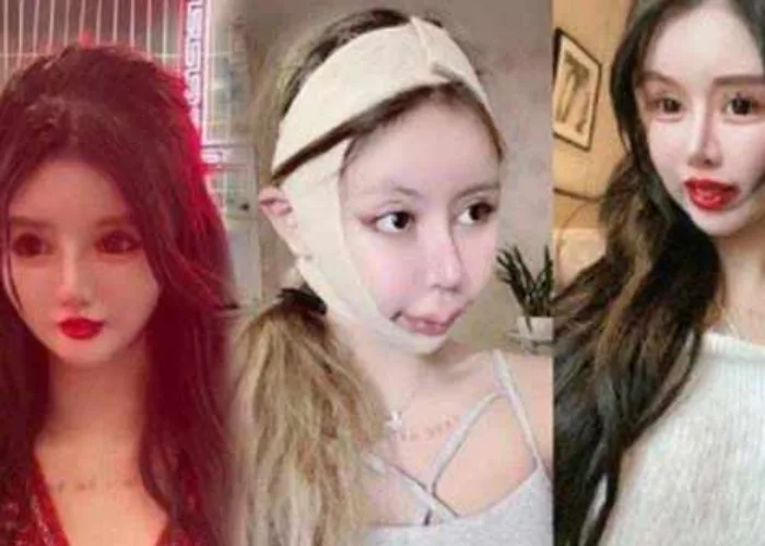 Gadis Remaja Ini Lakukan 100 Kali Operasi Plastik Demi Tampil Cantik, Begini Hasilnya