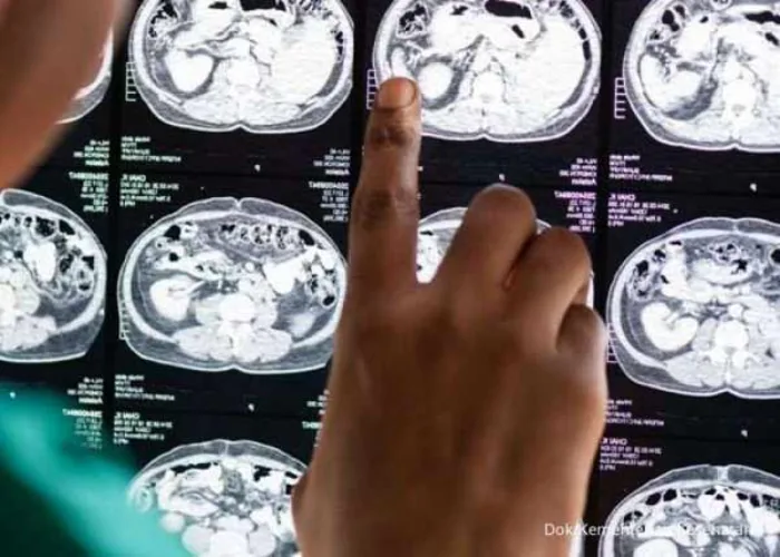 Kenali Gejala Stroke dan Cara Penanganannya